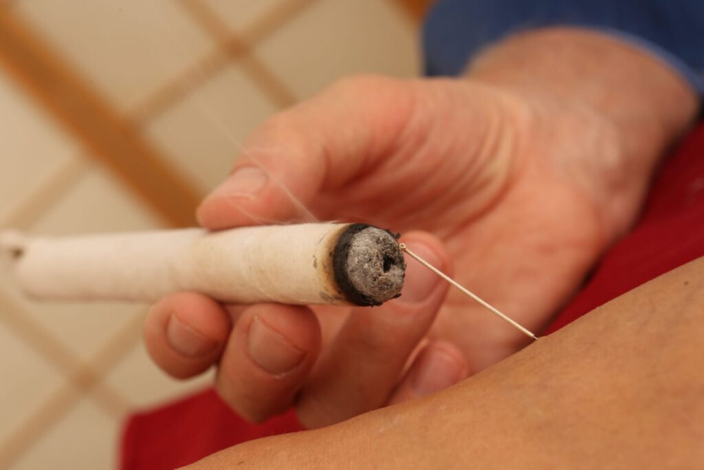 Moxibustion-Anwendung in der Klinik am Steigerwald zur ergänzenden Behandlung von Polyneuropathie mit traditioneller chinesischer Medizin
